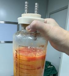 安阳水动力吸脂手术要做多久？